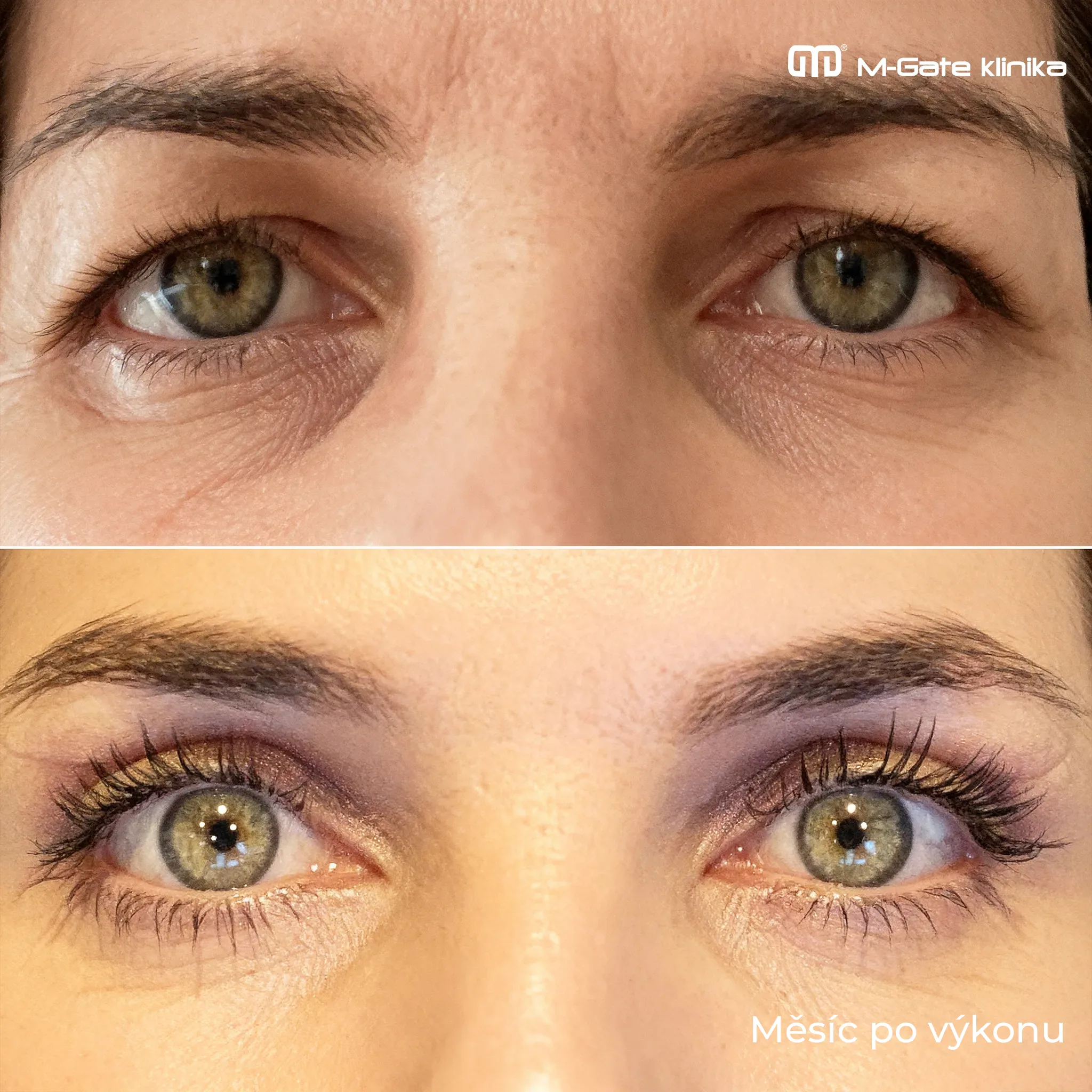 Operace víček - 15