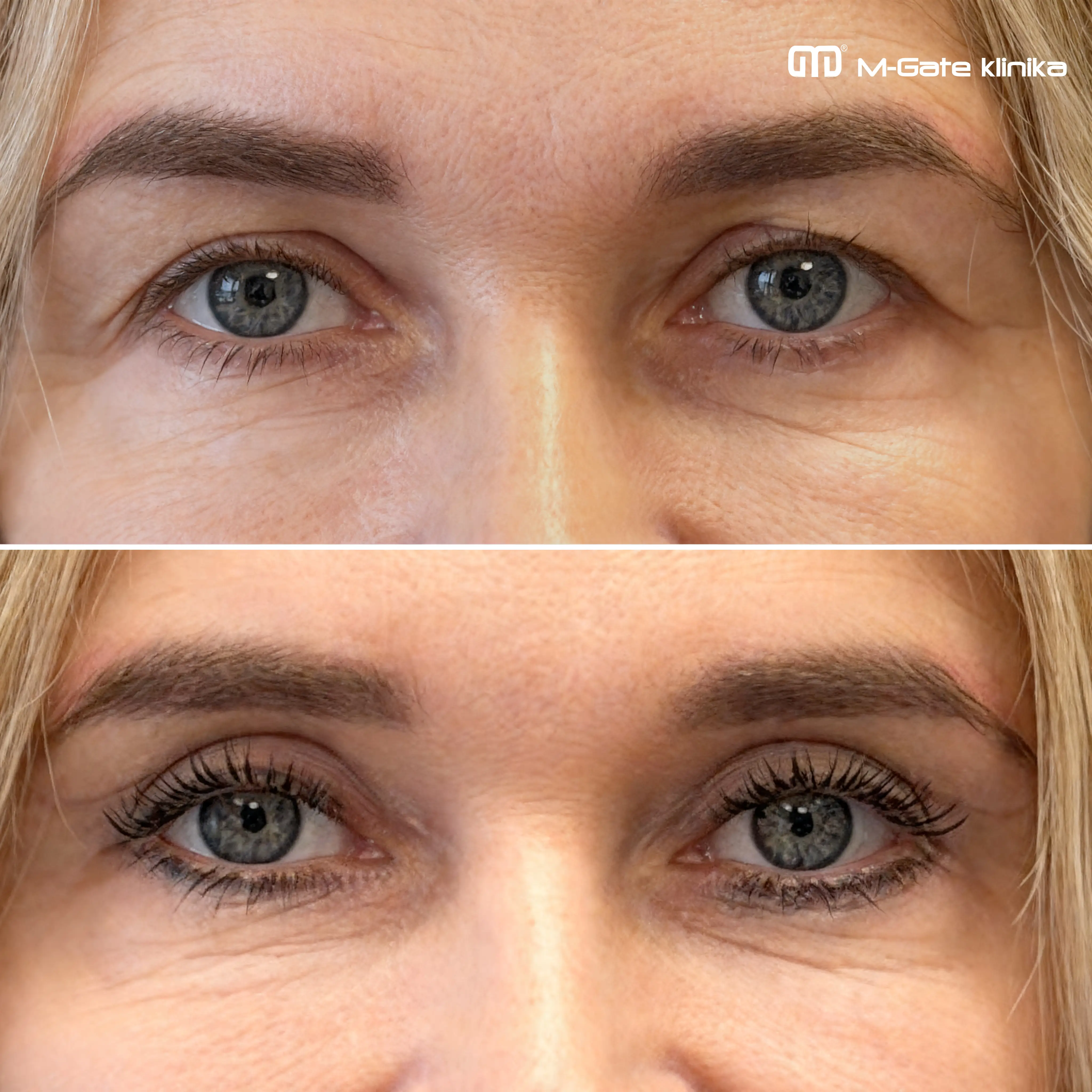 Operace víček - 18